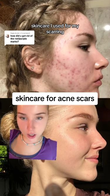 4 Products You need to Heal Acne Scarring Skincare For Acne, Clear Skin Diet, Skincare Guide, Forehead Acne, Skin Diet, Acne Scarring, Acne Solutions, Scarring, Facial Skin Care Routine