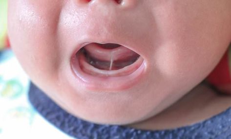 Over 60% of 'tongue-tied' babies don't need surgery, study suggests Upper Lip Tie, Baby Tongue, Myofunctional Therapy, Laser Surgery, Tongue Tie, Pediatric Dentist, Lactation Consultant, Pediatric Dentistry, Kids Health