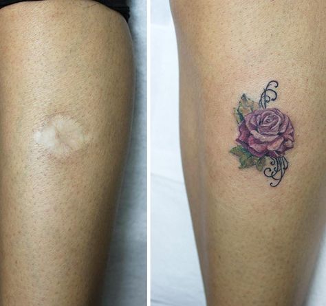 10+ Amazing Tattoos That Turn Scars Into Works Of Art Tattoo To Cover Up Birthmark, Tattoo Over Burn Scar, Tattoo Coverups, Scars Tattoo, Tattoo Over Scar, Rachel Khoo, Scar Cover Up, Tattoos To Cover Scars, Scar Tattoo