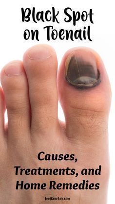 Nail Infection Black Spot On Toenail, Black Toenail Fungus, Toenail Health, Black Toe Nails, Nail Remedies, Toenail Fungus Remedies, Nail Fungus Remedy, Nail Infection, Fungal Nail