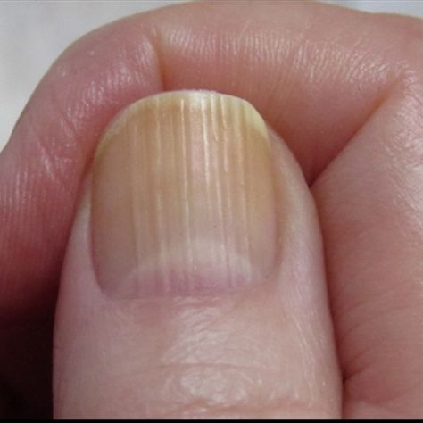 What nails reveal about health | Vertical Ridges Vertical Ridges On Fingernails, Vertical Nail Ridges, Fingernail Ridges, Nail Health Signs, Fingernail Health, Nail Ridges, Nail Conditions, Warts Remedy, Nail Problems