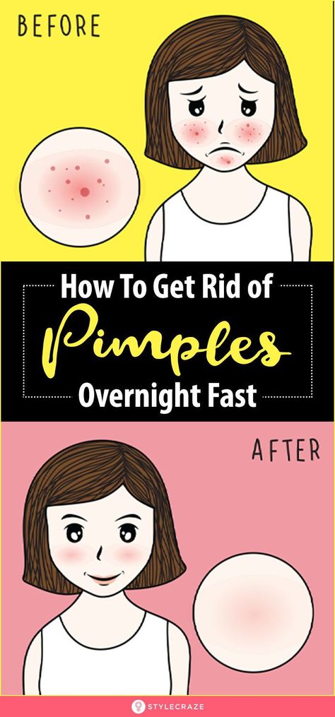 Homemade Pimple Patch, Remove Pimples Overnight, Get Rid Of Pimples Overnight, Rid Of Pimples Overnight, Back Acne Remedies, Blind Pimple, Get Rid Of Pimples, Rid Of Pimples, Pimples Under The Skin