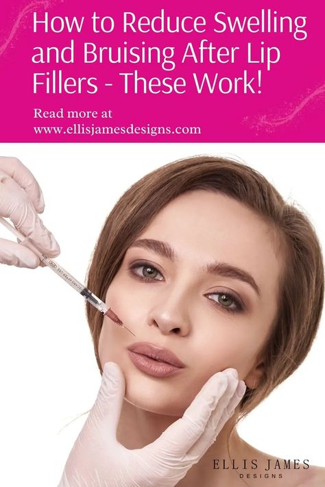 First Time Lip Fillers, Lip Filler For Uneven Lips, Lip Filler Swelling, Lip Filler Swelling Day By Day, Lip Fillers Bruising, Migrated Lip Filler, Bruising After Lip Filler, Juvederm Before And After, Filler Migration Lips