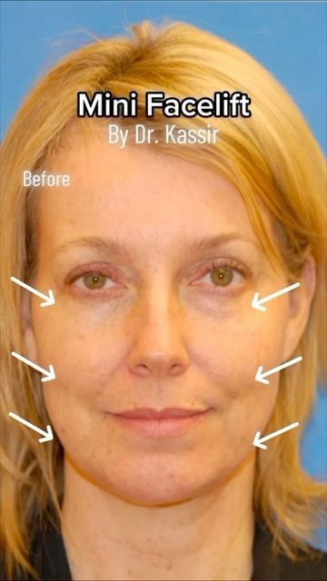 Plastic Surgeon Dr. Kassir on Instagram: "Only 5 days after Mini Facelift 😍 (under local anesthesia)

Just like a full facelift, the Band Aid Facelift separates and tightens the underlying muscles and removes excess skin on the cheeks and jawline. A Band Aid Face Lift is our version of a mini face Lift so less recovery and you can get back to work faster.

After the procedure we combined it with CO2 Laser Skin Resurfacing. It involves using lasers to help improve skin texture and appearance.
You might consider Laser Skin Resurfacing if you have aged, acne-related skin care concerns that aren’t treatable with over-the-counter products.

Her jowls, jawline and neck bothered her and she wanted a fresher look.

While nonsurgical options are always available, when you have:

1.  Gravity change Lower Face Lift Before And After, Mini Face Lift Before And After, Lower Face Lift, Mini Face Lift, Local Anesthesia, Laser Skin Resurfacing, Face Lift Surgery, Excess Skin, Skin Resurfacing