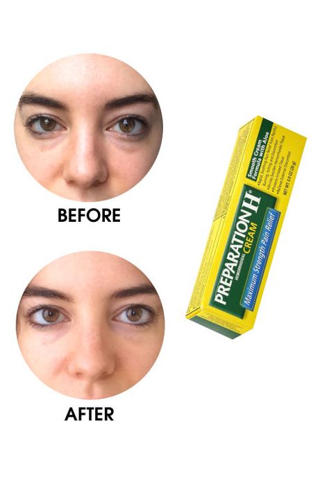 What's really the best way to depuff your eyes? An ELLE.com editor tests the most popular products, devices, and home remedies, documenting the befores and afters only through the unfiltered (and un-Facetuned) lens of an iPhone. The honest results of each, including Preparation H Hemorrhoidal-Cream Maximum Strength here. Bags Under Eyes, Preparation H, Dry Eyes Causes, Under Eyes, Dark Circles Under Eyes, Under Eye Bags, Puffy Eyes, Eye Bags, Black Tea