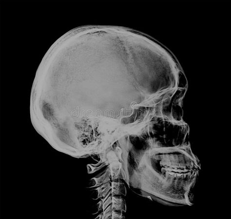 Human Skull Xray Negative Scan. A medical xray side view scan of the human head. You can see the bones of the skull, spine, jaw, and face royalty free stock photos X Ray Skeleton, Skull Xray, Bones Of The Skull, Real Human Skull, Sun Printing, Xray Art, Skull Anatomy, Indian Skull, Head Drawing