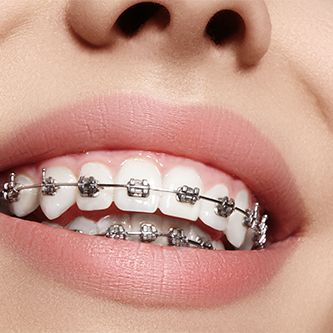 Teeth Aesthetic, Pretty Teeth, Adult Braces, Teeth Alignment, Cute Braces, Discolored Teeth, Brace Face, Crooked Teeth, Braces Colors