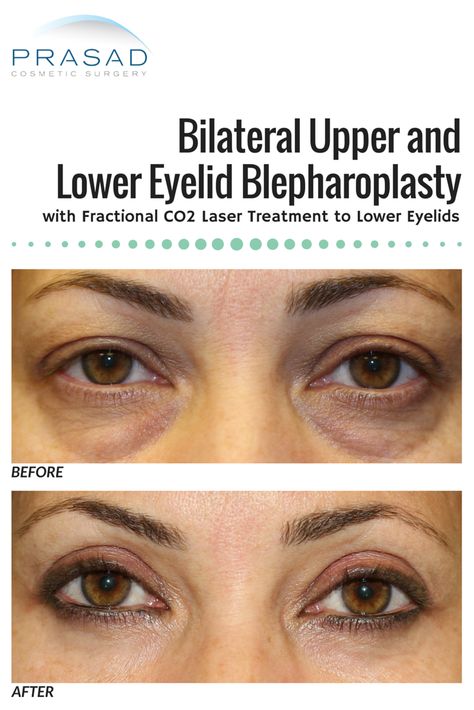 Eye Lid Surgery Before And After, Eye Lift Surgery, Mommy Makeover Surgery, Eyelid Lift, Good Photo Editing Apps, Upper Eyelid, Facial Rejuvenation, Eye Surgery, Eye Lift