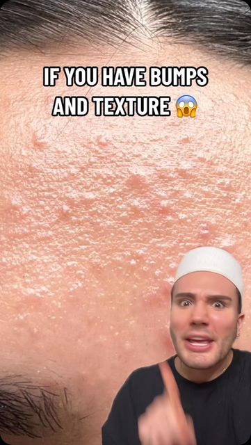 Matt Randon 🧩 on Instagram: "HOW TO GET RID OF BUMPS AND TEXTURE!😱 (follow for more!💗)

@eqqualberry_us partner. If you have sensitive skin using a Protease toner like this one instead of AHA or BHA toner is much better!🥳

#acnetreatment #acnepositivity #acneproblems #skincarecommunity #skincarejunkie #skincareaddict #skincarelover #kbeauty #koreanskincare #arencia" Toner For Oily Acne Prone Skin, Get Rid Of Skin Texture, Matt Randon, Hydrogen Peroxide Acne, Rash Care, Bha Toner, Pimple Solution, Acne Help, Hormonal Acne