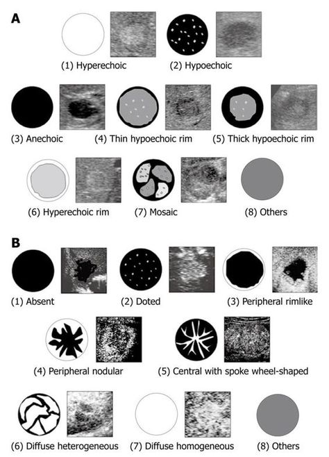 llustration of morphologic patterns of hepatic tumors in the B-mode ultrasonography; B: Illustration of enhancement patterns of hepatic tumors in the arterial phase Diagnostic Medical Sonography Student, Ultrasound School, Ultrasound Physics, Obstetric Ultrasound, Radiologic Technology, Vascular Ultrasound, Sonography Student, Ultrasound Sonography, Medical Ultrasound