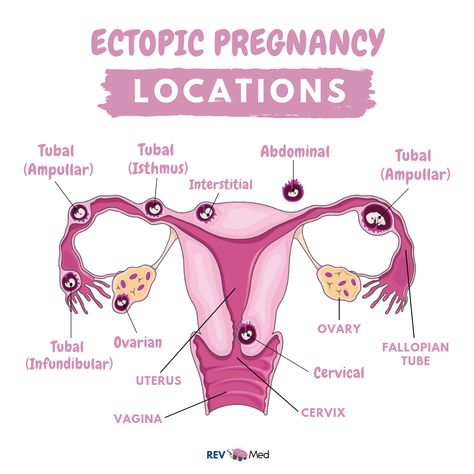 Ectopic Pregnancy and its locations, we’re doing some more reproduction today Instagram @rev.med! ⁣⁣ ⁣⁣ Basically Ectopic Pregnancy is when the fertilized egg implants somewhere other than the main cavity of the uterus.⁣⁣ ⁣⁣ Possible causes of an ectopic pregnancy include a damaged fallopian tube, hormonal imbalances, abnormal development of the fertilized egg and it most often occurs in the Fallopian tubes. ⁣⁣ See more and subscribe to our YouTube channel /revmedicine Obstretics And Gynecology, Medications Nursing, Obstetric Ultrasound, Pregnancy Images, Midwifery Student, Hormonal Imbalances, Nursing School Essential, Anatomy Lessons, Medical School Life