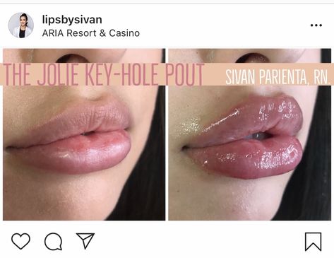 Key hole lip filler Botox Lip Filler Inspiration Heart Shaped, Keyhole Lip Fillers, Different Lip Filler Shapes, Keyhole Lips, Key Hole Lip Filler, M Shaped Lips With Filler, Keyhole Pout Lips, Surgery Inspiration, Keyhole Pout Lip Filler