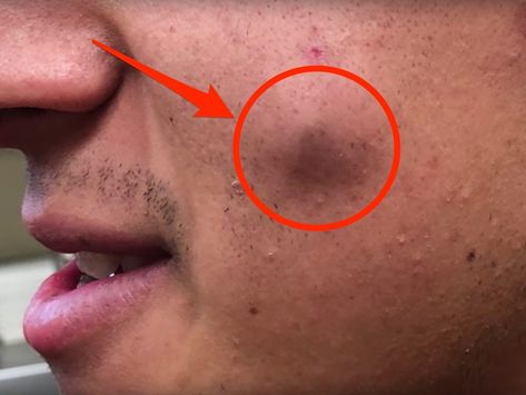 Pimple On Eyelid, Hard Pimple, Lip Pimple, Head Pimples, Huge Pimple, Ear Pimple, Back Pimples, Pimple Popper Tool, Cystic Pimple