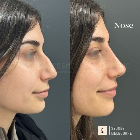 Our non-surgical rhinoplasty is a 15-minute injectable procedure that immediately improves the appearance of your nose. It’s a highly effective solution that can: - Hide bumps and humps - Lift and refine your nose tip - Slim and define your nose bridge - Balance the shape and size of your nose - Straighten a crooked nose - Improve poor surgical rhinoplasty results ⁠ Did you love this result? Want to know if it's right for you? Comment 'NOSE' to claim your complimentary opinion. ⁠⁠⁠ This con... Neck Lift Surgery, Double Chin Reduction, Nose Fillers, Nose Tip, Crooked Nose, Nose Jobs, Chin Augmentation, Nose Reshaping, Anti Wrinkle Injections