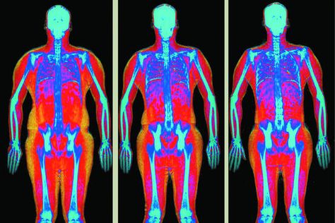 The Claim: A whole-body scan, called Dual-Energy X-ray Absorptiometry, or DXA for short, gives a detailed snapshot of your body composition,... Leeds Beckett University, Liverpool John Moores University, Pet Ct, Body Scan, Exercise Physiology, Body Fat Loss, Body Fat Percentage, Body Map, Body Scanning