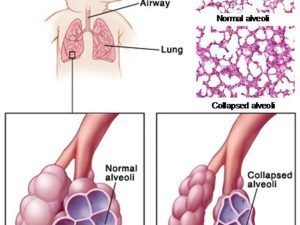 Normal & abnormal lung compliance, Elastance, Surfactant and work of breathing Respiratory System Function, Bronchopulmonary Dysplasia, Respiratory Distress, Natural Decongestant, Respiratory Care, Respiratory Therapy, Lung Disease, Respiratory System, Anatomy And Physiology