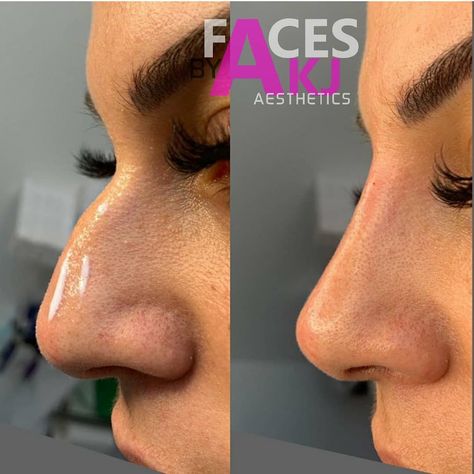 Non Surgical Rhinoplasty, Non Surgical Nose Job, Face Aesthetic, Nose Job, Side Profile, Surgery, Siding, Hair, On Instagram