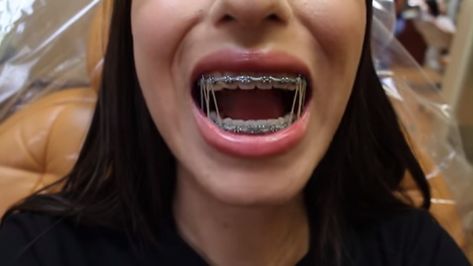 Braces Power Chain Aesthetic, Cute Braces With Rubber Bands, Powerchain Braces Aesthetic, Braces With Rubber Bands, Powerchain Braces Color, Pretty Braces, Yung Bleu, White Braces, Braces Colours