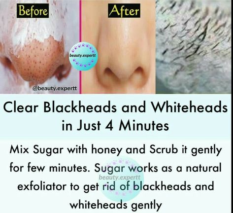 White Heads Removal, Clear Skin Remedies, Clear Blackheads, Clear Skin Face, Natural Face Skin Care, Good Skin Tips, Makeup Artist Tips, Get Rid Of Blackheads, Skin Remedies