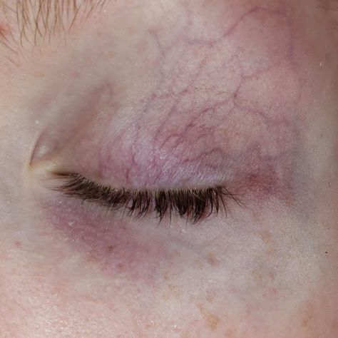 Veins Eye Makeup, Under Eye Veins, Dark Under Eye Circles Aesthetic, Eye Veins Makeup, Veiny Eyelids, Red Veins In Eyes, Veiny Skin, Body Details Aesthetic, Vein Makeup