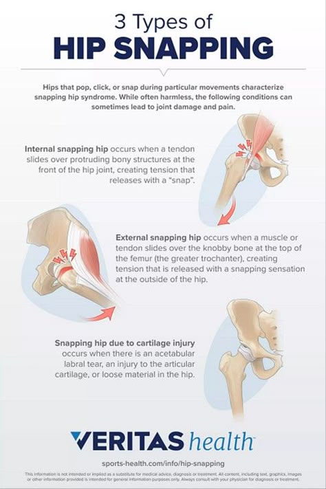 Physiotherapy Notes, Snapping Hip Syndrome, Physiotherapy Awareness Posters, Physiotherapy Knowledge, Hip Anatomy, Physical Therapy Humor Memes, Sports Physical Therapy, Physical Therapy Memes, Physical Therapy School