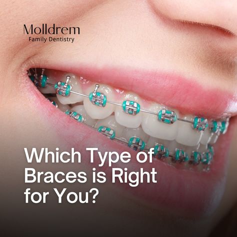 Brace yourself for some smile transformation knowledge! Swipe right to explore your options to a straighter smile! 😁✨ 1️⃣ Traditional Metal Braces: Classic but Cool 2️⃣ Ceramic Braces: Subtle and Sophisticated 3️⃣ Lingual Braces: The Hidden Heroes 4️⃣ Invisalign: Embrace the Invisible 🌐 Each option has its own unique benefits, and we've got all the details waiting for you in our full blog! Braces Transformation, Smile Transformation, Lingual Braces, Ceramic Braces, Types Of Braces, Sedation Dentistry, Metal Braces, Dental Veneers, Family Dentistry