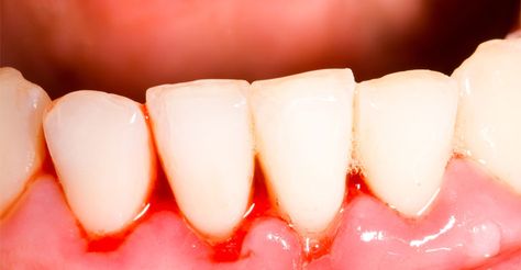 Why Are My Gums Bleeding? Have you noticed that when you eat or brush your teeth your gums bleed? 📞 Phone: (416) 247-1928 📬 Email: info@westondental.ca 📍 Location: 1928 Weston Rd, Toronto, ON M9N 1W2 #GumsBleeding #Gums #PreventGumsBleeding #TreatGumsBleeding #OralHealth #OralProblem #GeneralDentistry #CosmeticDentistry #TorontoGeneralDentistry #CosmeticDentistryToronto #DentalCleaning Homeopathy Remedies, Swollen Gum, Gum Care, Gum Health, Homeopathic Remedies, Natural Home Remedies, Healthy Teeth, Homeopathy, Oral Hygiene