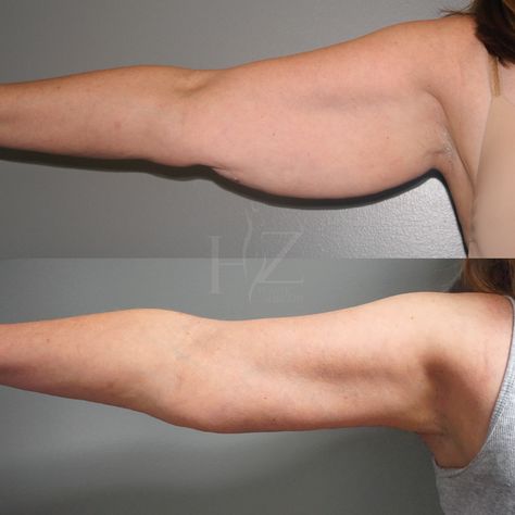 Arm Lift Surgery Before And After, Thigh Lift Surgery, Arm Lift Surgery, Thigh Lift, Beauty Maintenance, Arm Lift, Mommy Makeover, Arm Fat, Leg Lifts