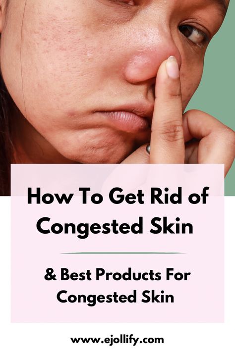 How To Get Rid of Congested Skin & Products For Congested Skin Clearing Clogged Pores, Skin Care Routine For Whiteheads, Best Products For Clogged Pores, How To Treat Blackheads On Nose, How To Get Rid Of Congested Skin, How To Deep Clean Pores, How To Treat Whiteheads, How To Treat Pores On Face, Skin Care For Clogged Pores