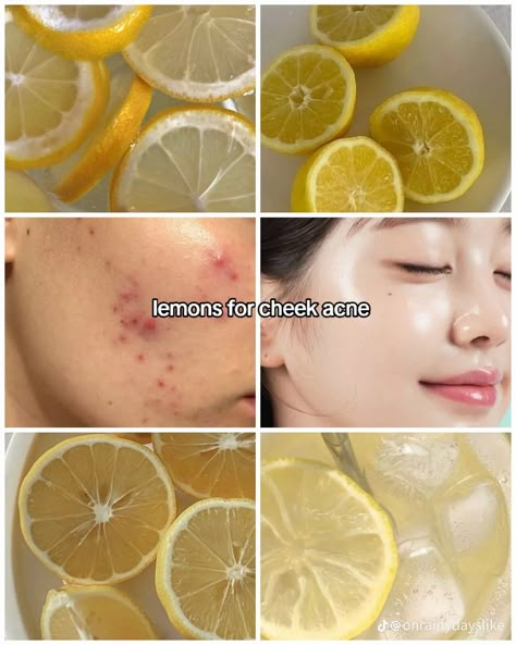 Lemon For Face, Fruits For Glowing Skin, Cheek Acne, Foods For Clear Skin, Beginner Skin Care Routine, Korean Skin Care Secrets, Beauty Treatments Skin Care, Skin Advice, Natural Face Skin Care