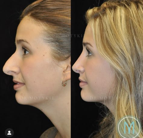 Nose Tip Surgery Before After, Nose Job Before And After Rhinoplasty, Nosejob Rhinoplasty Before After, Nose Jobs Before And After, Plastic Surgery Before And After, Rhinoplasty Before After, Nose Job Before And After, Nose Job Inspo, Before And After Nose Job