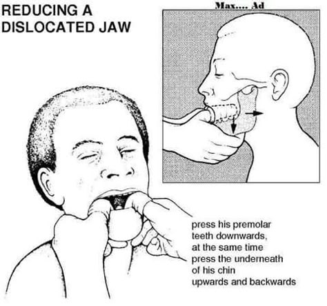 Dislocated Jaw, Punkty Spustowe, Dental World, Kedokteran Gigi, Dental Hygiene School, Dentistry Student, Human Body Unit, Dental Anatomy, Yoga Anatomy