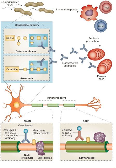 gbs pathophysiology Chronic Inflammatory Demyelinating Polyneuropathy, Transverse Myelitis, Guillain Barre, Guillain Barre Syndrome, Nursing Board, Peripheral Nerve, Cerebrospinal Fluid, Nursing School Notes, Bacterial Infection