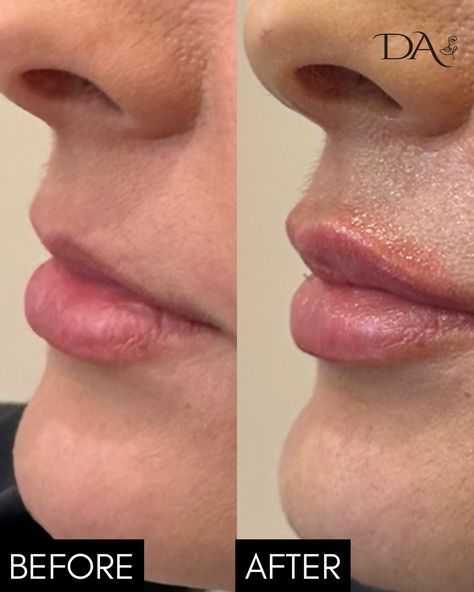 Plump, smooth, and simply gorgeous 👄 

What are some of the benefits of lip filler?

💋 Instant volume and definition for fuller lips
✨ Subtle, natural-looking results that enhance your features
👄 Smooth out fine lines and wrinkles around the lips
🌟 Boost  confidence and enhances your smile
⏱️ Quick, non-surgical procedure with minimal downtime
💖 Customizable to your desired shape and look
🌱 Long-lasting results with proper care

Our pretty patient pictured came to @direct_aesthetics seeking b... Fuller Lips, Lip Filler, Short Hair Tutorial, Boost Confidence, Lip Fillers, Confidence Boost, Fine Lines And Wrinkles, Your Smile, Hair Tutorial