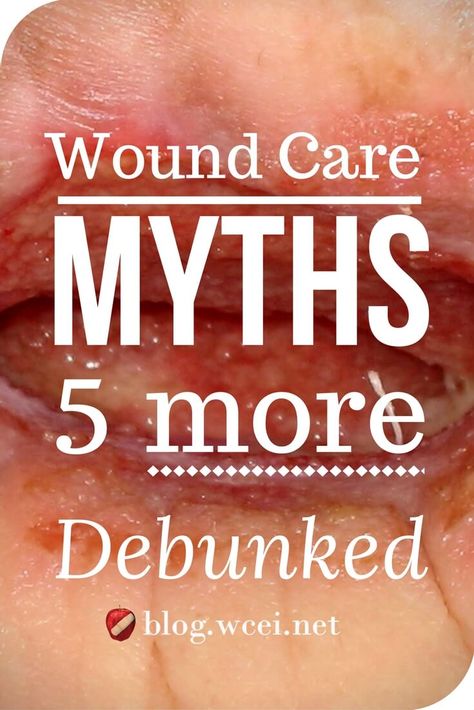 Wound Care Myths: 5 More Debunked - There are still plenty of wound care myths out there. Ready for the truth? You can handle it. via @woundcareeducat Natural Wound Care, Heal Wounds Faster, Wound Care Nursing, Ostomy Care, Leg Ulcers, Pressure Ulcer, Wound Dressing, Wound Care, Nursing Study