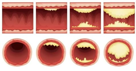 Unclog Arteries, Healthy Holistic Living, Clogged Arteries, Protect Your Heart, Cardiovascular System, Natural Health Remedies, Lower Blood Pressure, Back To Nature, Heart Health