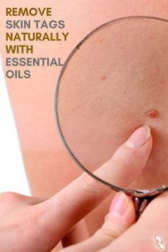 Skin Tags Essential Oils, Remove Skin Tags, Remove Skin Tags Naturally, Losing 40 Pounds, Skin Natural Remedies, Skin Tags, Essential Oils Health, Cold Sores Remedies, Essential Oils For Skin