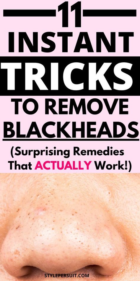 How to Get Rid of Blackheads: 12 Blackheads Removal Home Remedies That Work Like Magic What Are Blackheads, Remove Blackheads From Nose, Blackhead Remedies, Blackheads On Nose, Rid Of Blackheads, Blackheads Removal, Homemade Scrub, Inflammation Causes, Get Rid Of Blackheads