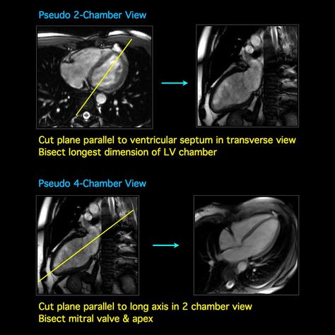 Pseudo 2 & 4-Chamber Views Short Axis View 4-Chamber View Left 2-Chamber View 3-Chamber View Left Ventricular Outflow Tract (... Mri Anatomy, Mitral Valve, Rad Tech, Heart Images, Cross Section, Radiology, Anatomy, Medicine, Quick Saves