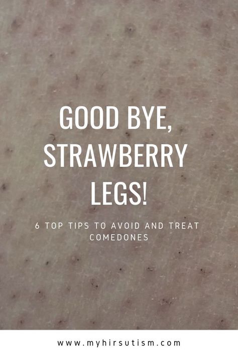 Comedones or strawberry legs are annoying. Here's how to get rid of them for good! Bumps On Legs Get Rid Of, How To Get Rid Of Shaving Bumps, Strawberry Bumps On Skin, Remove Strawberry Legs How To Get Rid, How To Remove Strawberry Legs At Home, Strawberry Skin How To Get Rid, Strawberry Legs Remedy How To Get Rid, Face Hair Removal Permanent, Strawberry Legs Remedy