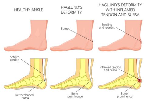 Haglund's Deformity - Plantar Fascia Institute of MN Runners Strength Training, Achilles Bursitis, Calf Muscle Pain, Haglunds Deformity, Achilles Tendon Ruptures, Sore Calves, Achilles Tendinopathy, Achilles Pain, Plantar Fascia