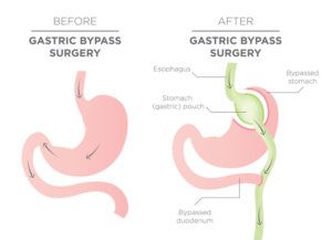 Gastric Problem, Sleeve Gastrectomy, Sleeve Surgery, Laparoscopic Surgery, Bypass Surgery, Gastric Bypass, Surgery, Vision Board