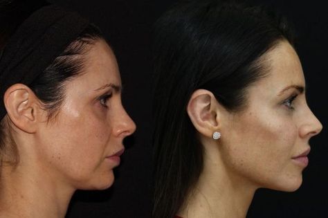 Harley Street skin guru Dr Tapan Patel is using this technique to help women look younger for longer Mid Face Filler, Jawline Filler, Face Injections, Sculpt Face, Chin Filler, Chin Augmentation, Chin Implant, Face Fillers, Strong Jawline