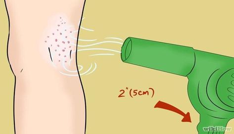 Chigger Bite Remedy, Red Bug Bites, Bug Bites Remedies, Medical Facts, Bug Bites, Insect Bites, Homemade Remedies, Health Remedies, Home Remedies