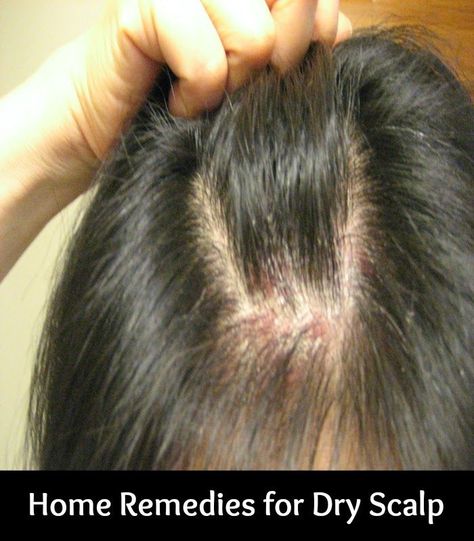 Home Remedies For Dry Scalp Scalp Scabs, How To Remove Dandruff, Dry Scalp Remedy, Scalp Acne, Thick Hair Remedies, Hair Remedies For Growth, Grow Hair Faster, Itchy Scalp, Scalp Health