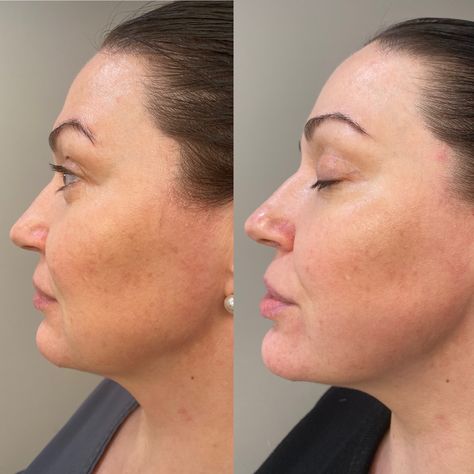 Facial Before And After, Skin Therapist, Face Lifting, Face Lift, Animated Love Images, Love Images, Esthetician, Skin Treatments, Massage