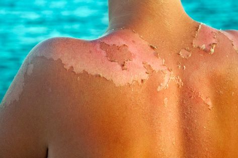 Sunburn Peeling, Bad Sunburn, Natural Face Care, Perfect Skin Care Routine, Peeling Skin, Skin Care Women, Healthy Alternatives, Natural Skin, Natural Skin Care