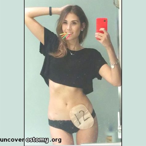 Uncover-Ostomy-12-Year Ostomy Fashion, Ostomy Life, Ostomy Bag, Ehlers Danlos Syndrome, Nursing Notes, Lifestyle Changes, Inspirational People, Thing 1 Thing 2, Fitness Inspo