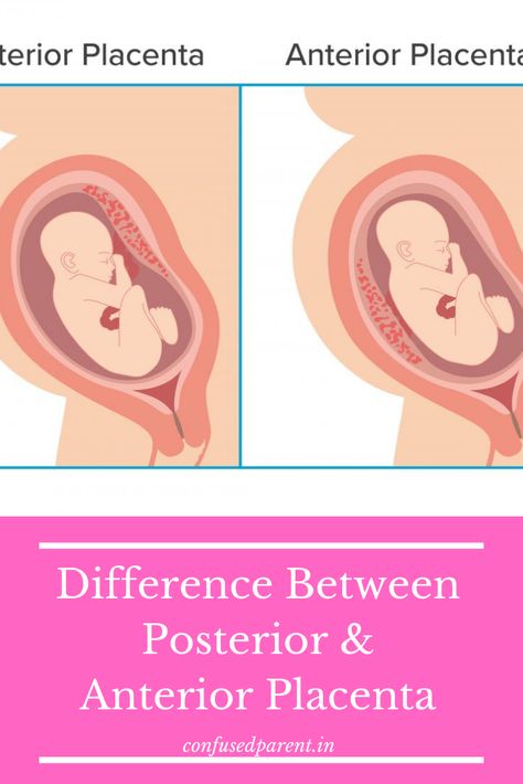 Pregnancy is an important stage in a woman’s life where every trimester has to be continuously monitored. Your gynecologist or health care provider will do this with the help of tests and scans. The most important one, as you must be all aware of, is an ultrasound. This test is done in the second trimester aiming to find out the position of the placenta. As this mainly determines whether the delivery will be normal or a C-section. How? Read more on What Is Placenta Posterior – Anterior Placenta Gender Prediction, Posterior Baby, Anterior Placenta, Antenatal Care, Diagnostic Medical Sonography Student, Sonography Student, Cardboard City, Healthy Birth, Medical Ultrasound