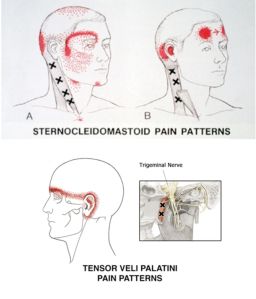 Trigeminal Nerve Branches, Trigeminal Nerve, Tmj Headache, Nerve System, Dentistry Humor, Esthetic Dentistry, Muscles Of The Neck, Holistic Dentistry, Referred Pain